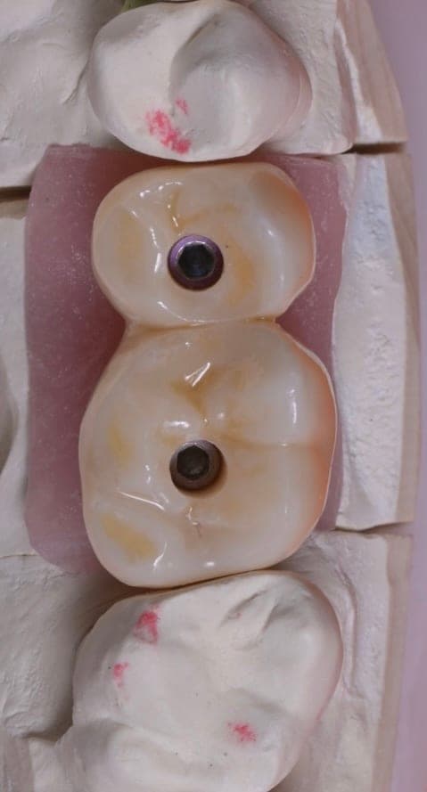 Dental Implants